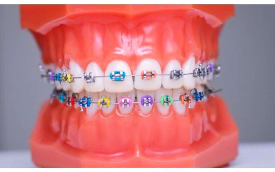 Life of An Orthodontic Dental Nurse – Perfect Smiles